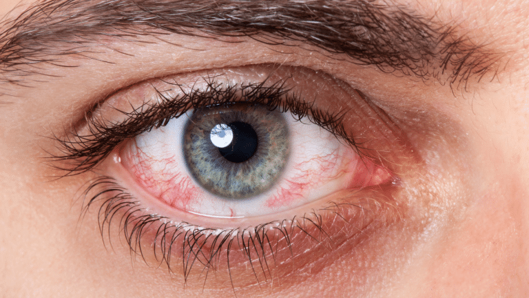 ¿El uso del cannabidiol provoca el enrojecimiento de los ojos?
